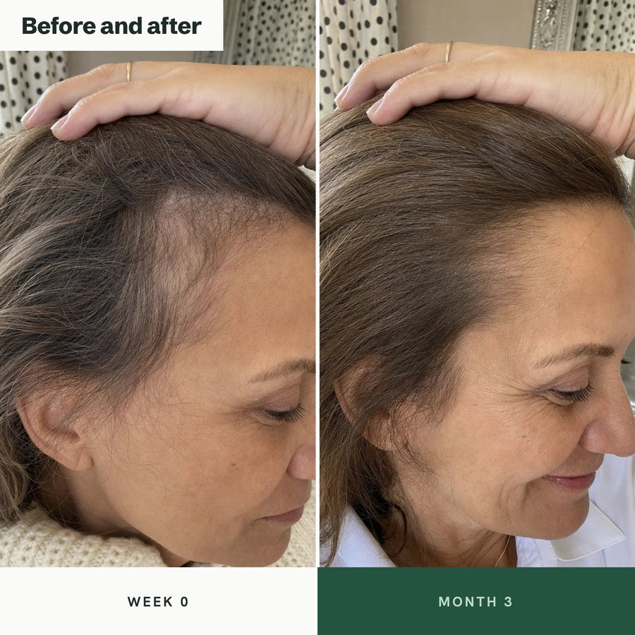 Before and after: hairline and temple at week 0 and month 3